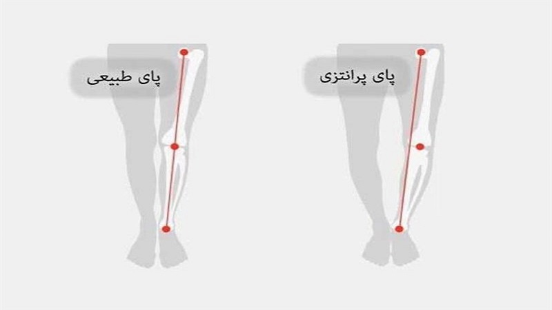 جراحی زانو پرانتزی | دکتر سینا طالبی | بهترین جراح زانو اصفهان | بهترین جراح رباط صلیبی اصفهان | بهترین تعویض مفصل زانو اصفهان