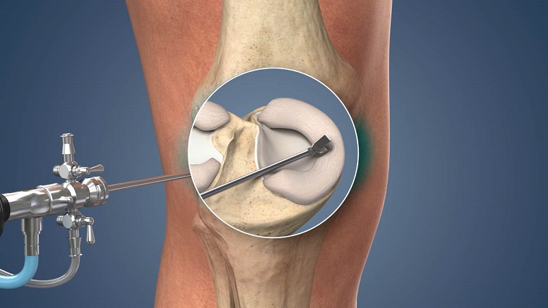بهترین جراح مینیسک زانو اصفهان | دکتر سینا طالبی | بهترین جراح زانو اصفهان | بهترین جراح رباط صلیبی اصفهان | بهترین تعویض مفصل زانو اصفهان