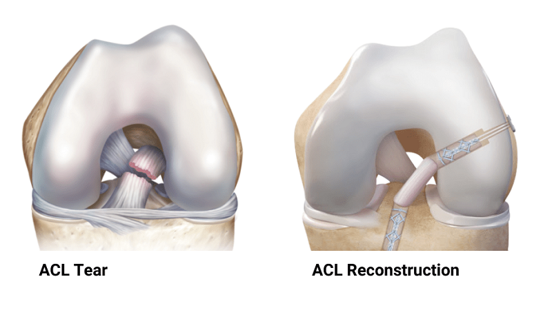 مدیریت پارگی‌های مزمن ACL | دکتر سینا طالبی|بهترین جراح رباط صلیبی اصفهان|بهترین تعویض مفصل زانو اصفهان|بهترین جراح زانو اصفهان
