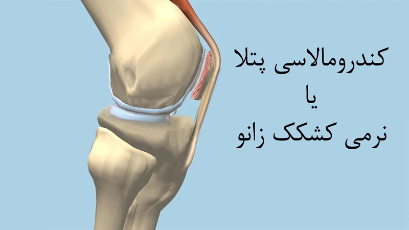 نرمی کشکک زانو | دکتر سینا طالبی | بهترین جراح زانو اصفهان | بهترین جراح رباط صلیبی اصفهان | بهترین تعویض مفصل زانو اصفهان