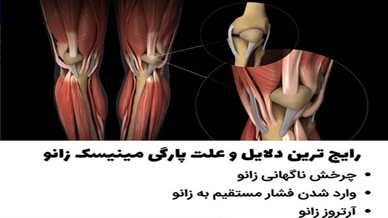 ساختار و عملکرد مینیسک‌ها |دکتر سینا طالبی | بهترین جراح زانو اصفهان | بهترین جراح رباط صلیبی اصفهان | بهترین تعویض مفصل زانو اصفهان