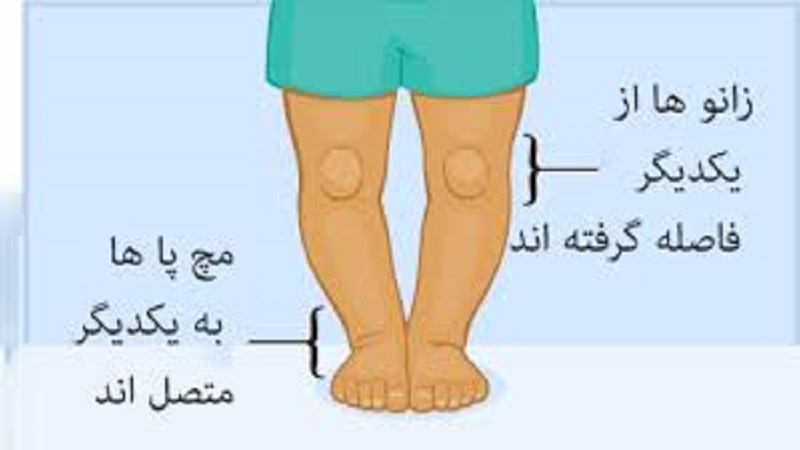 زانو پرانتزی در کودکان |دکتر سینا طالبی | بهترین جراح زانو اصفهان | بهترین جراح رباط صلیبی اصفهان | بهترین تعویض مفصل زانو اصفهان