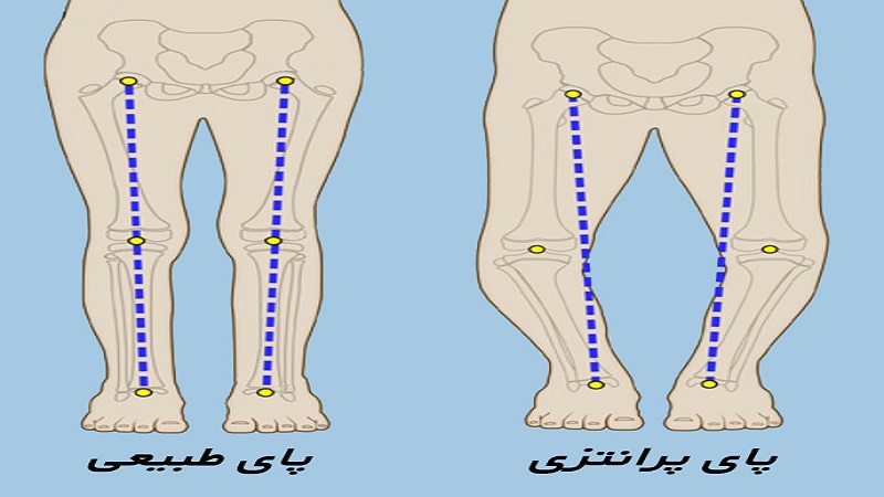 پیشگیری از زانو پرانتزی |دکتر سینا طالبی | بهترین جراح زانو اصفهان | بهترین جراح رباط صلیبی اصفهان | بهترین تعویض مفصل زانو اصفهان