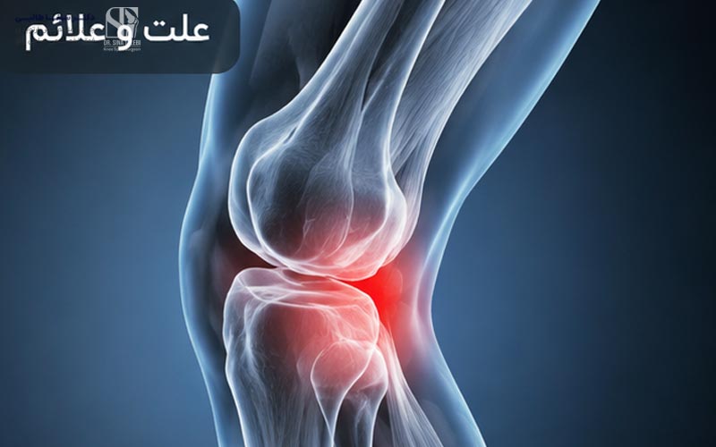 درد پشت زانو و آسیب مینیسک